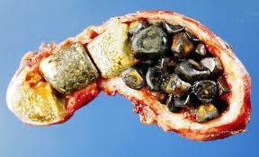 Gall stones