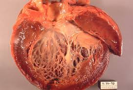 Diabetic Cardiomyopathy