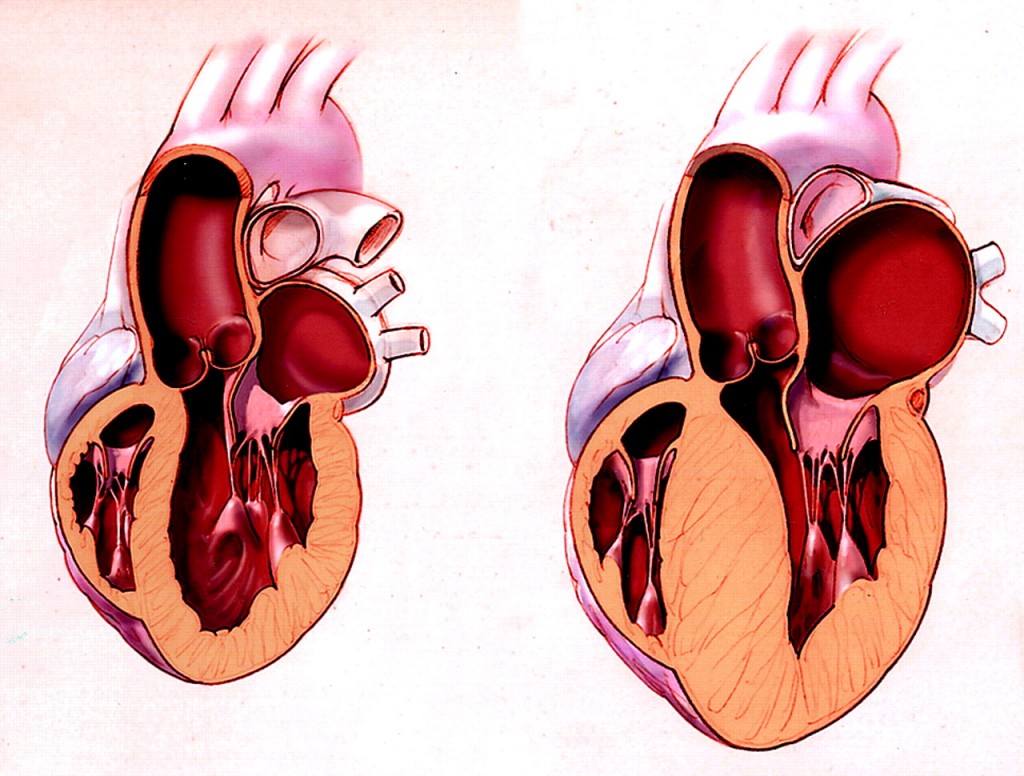 cardimyopathy