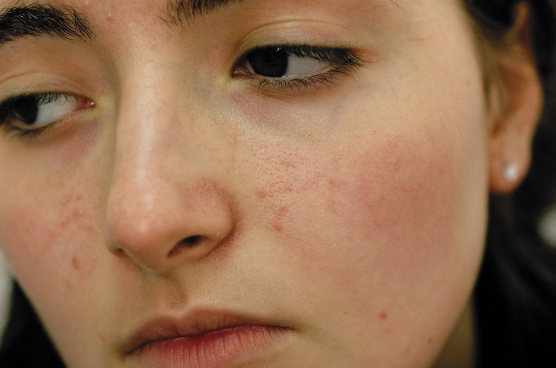 The Top 3 Natural Remedies For Dealing With Pimples Trainer