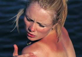 4 Natural Remedies For Dealing With Sunburn