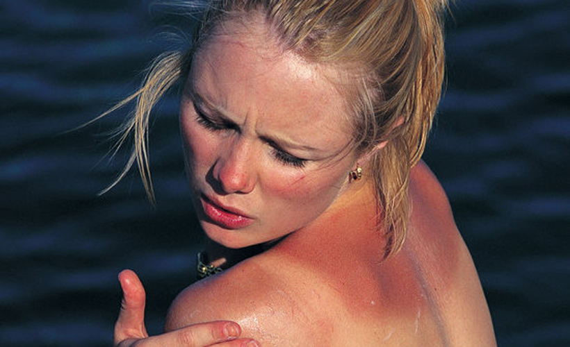4 Natural Remedies For Dealing With Sunburn