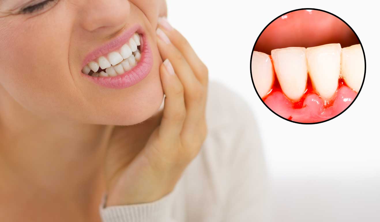 5 Ways to Stop Bleeding Gums