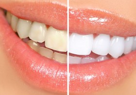 Natural Ways To Keep A Whiten Teeth And Odourless Mouth