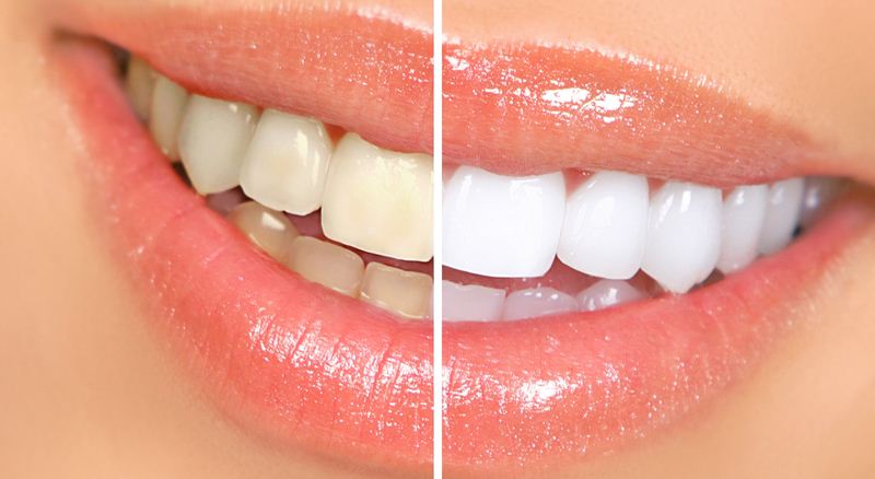 Natural Ways To Keep A Whiten Teeth And Odourless Mouth